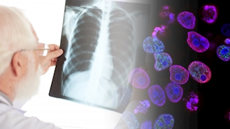 סרטן ריאות - אילוסטרציה, צילום: freepik, unsplash