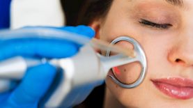 טיפולים בלייזר, צילום: shutterstock