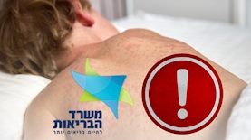 חצבת, צילום: shutterstock