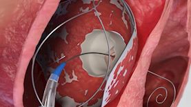 הדמיית השתלת המסתם, צילום: אולמד סולושנס